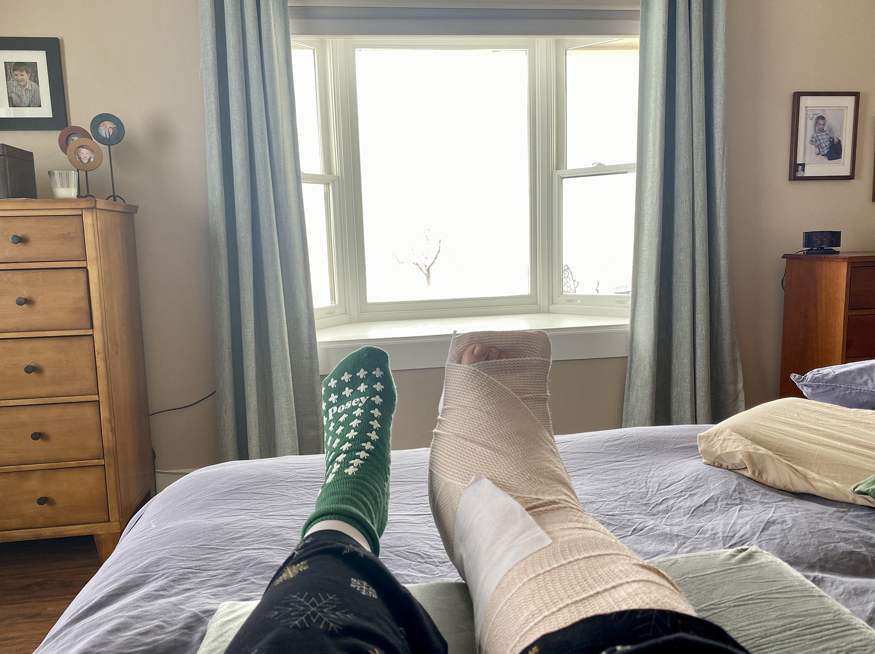 ankle ligament surgery recovery